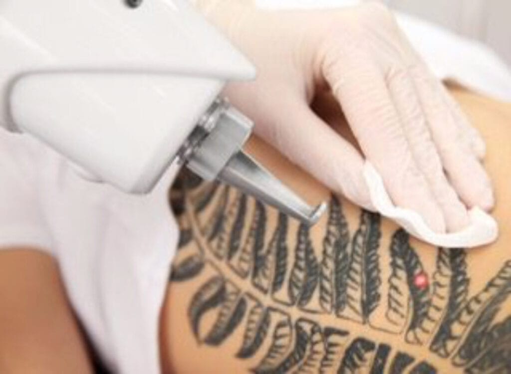tatuaż usuwanie tatuażu laser pielęgnacja