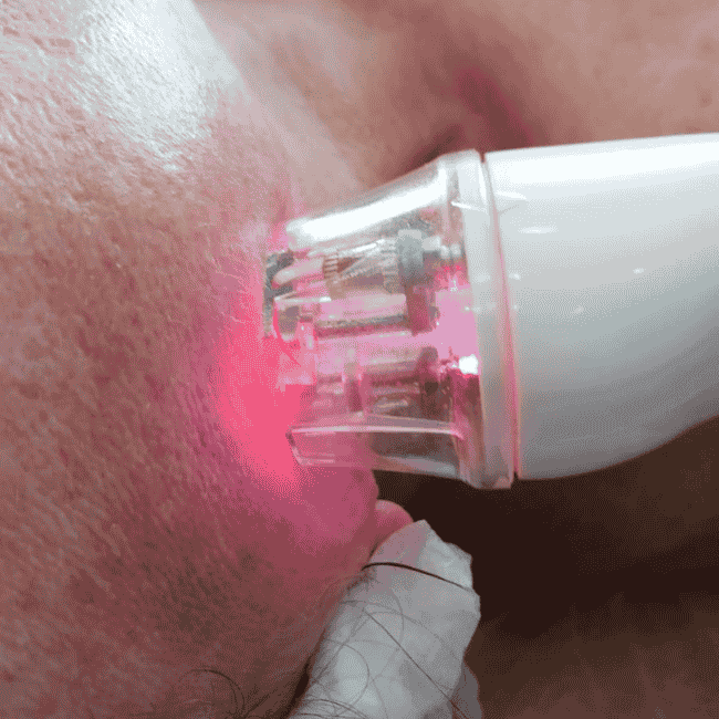 Radio wave head applied to the skin of the face