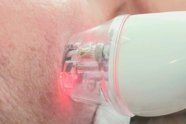 przeprowadzany jest zabieg - fale radiowe na twarzy. Widzimy dysze radiowa przylozona do skory.