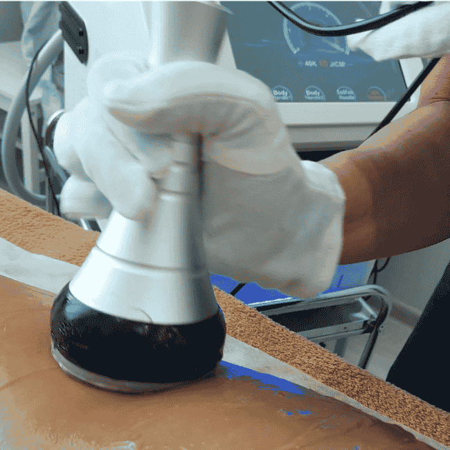 zabieg liposukcji ultradźwiękowej - przeprowadzanej na ciele