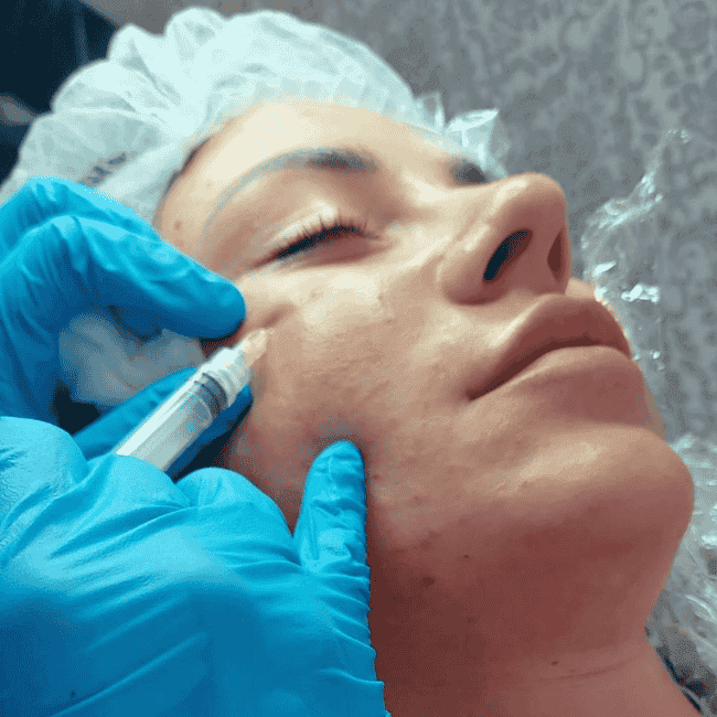 kosmetyczka wstrzykuje preparat pod skórę twarzy