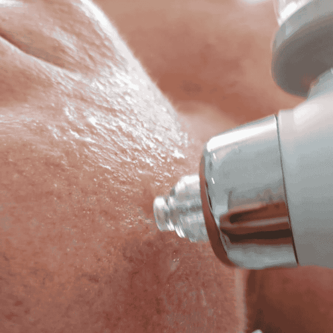 oxybrazja - zabieg przeprowadzany na twarzy klientki