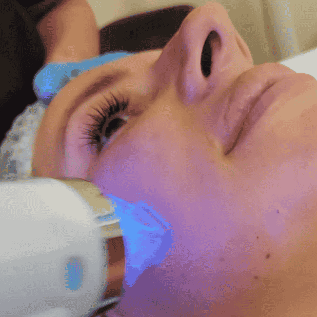 zabieg radiofrekwencji w trakcie. Glowica pracująca na twarzy klientki