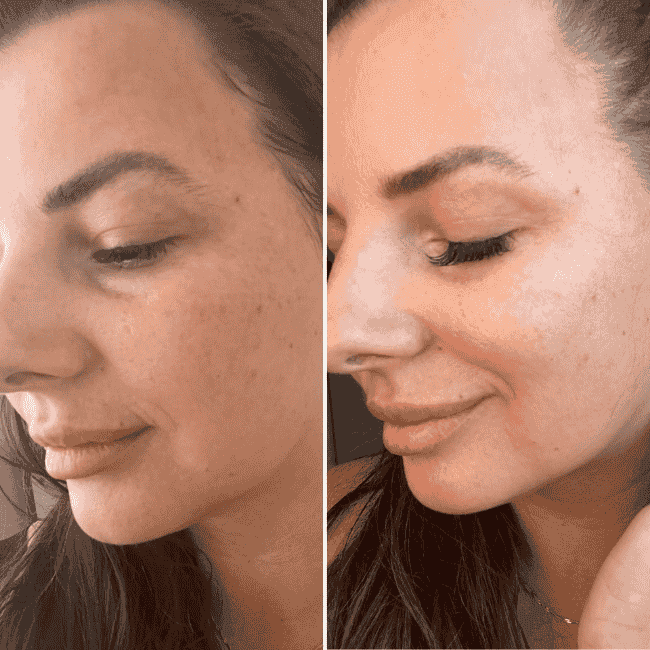 efekt stymulatorów tkankowych przed i po - profil klientki