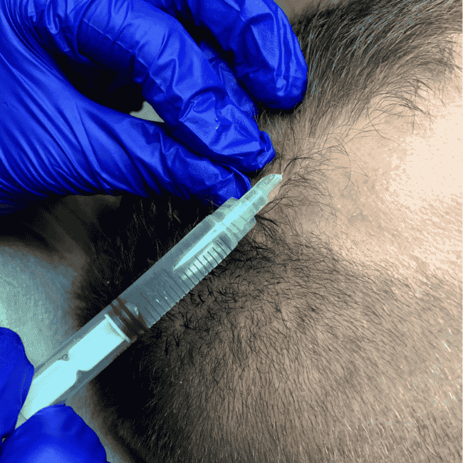 The beautician performs the procedure-inserts a needle into the scalp