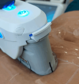 hifu head - guided along the abdomen