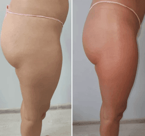 body before and after abbys treatment