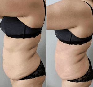 abdomen before and after surgery abbys