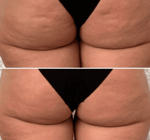 effect after one treatment abbys