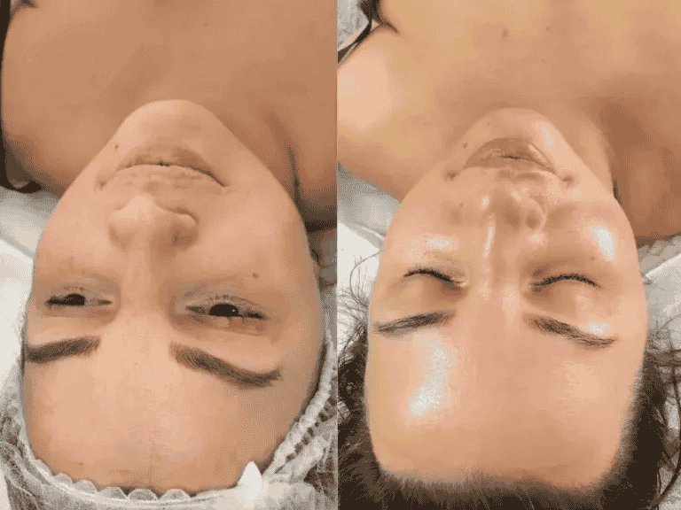 efekty zabiegu GENEO - na zdjęciu twarz Joanny - salon Maris Gdynia