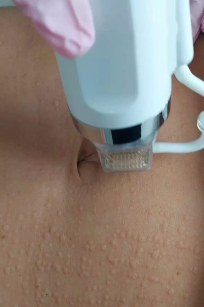 radiofrequency head - works on the abdomen