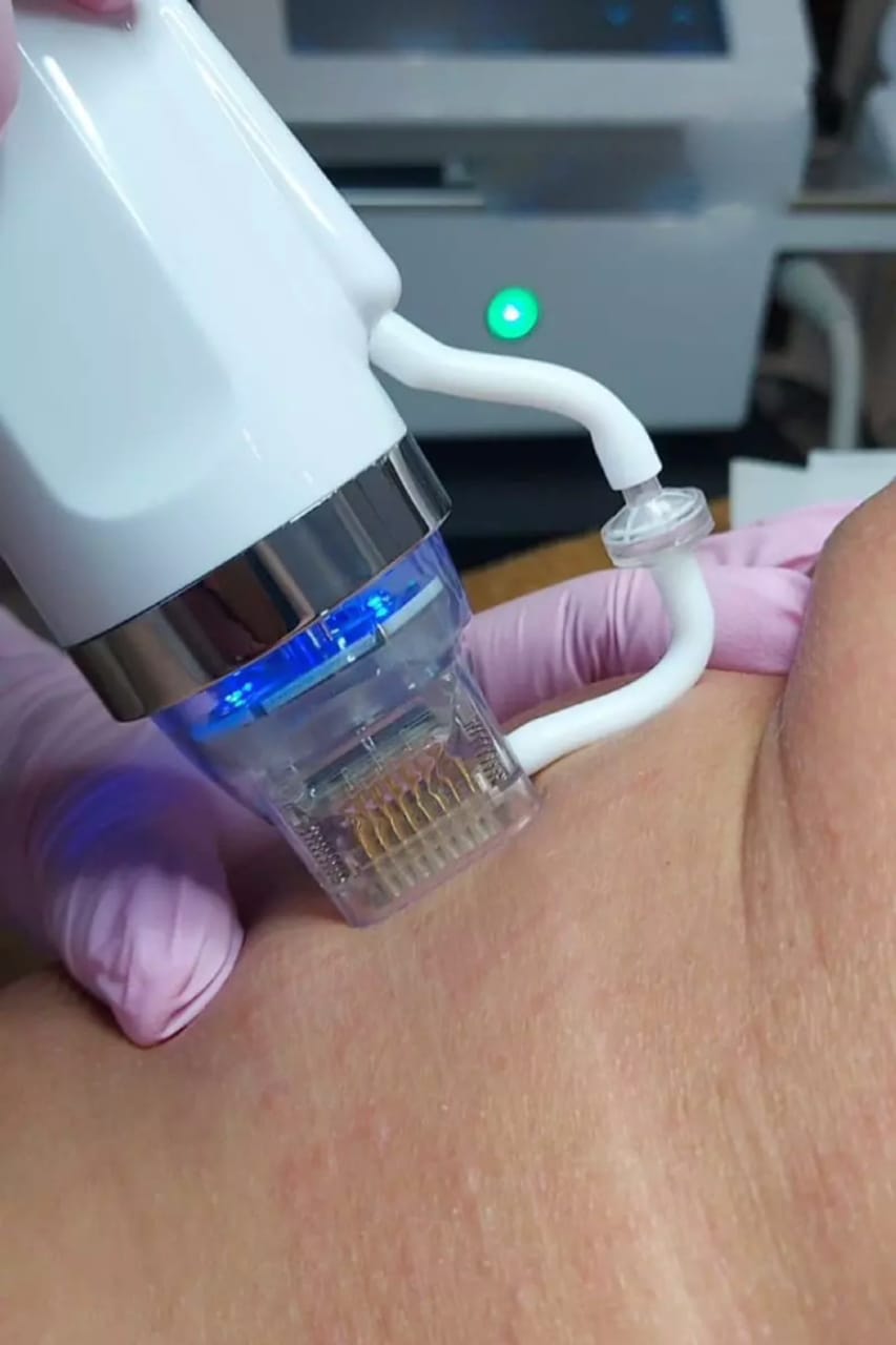 radiofrequency head - works on the skin of the abdomen