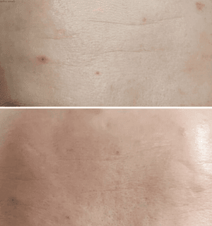 skin after one radiofrequency treatment