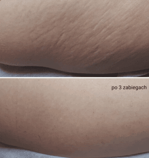 skin after three radiocarbon treatments