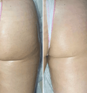 post-bladder before and after one treatment