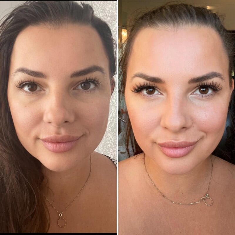 efekt przed i po zabiegu