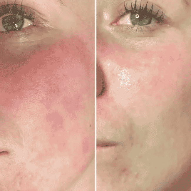 estgen effect before and after treatment