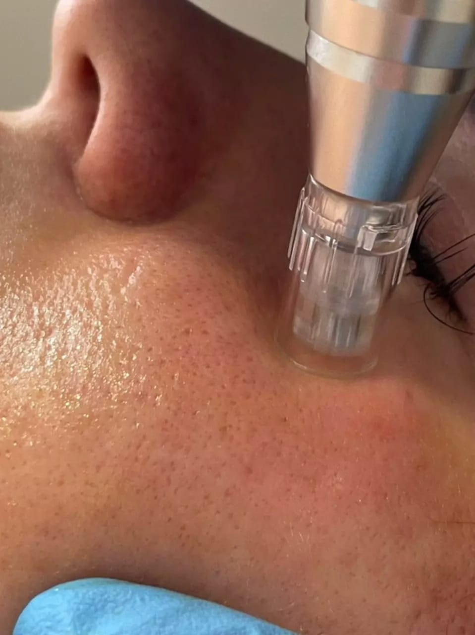 hydrogen facial cleansing