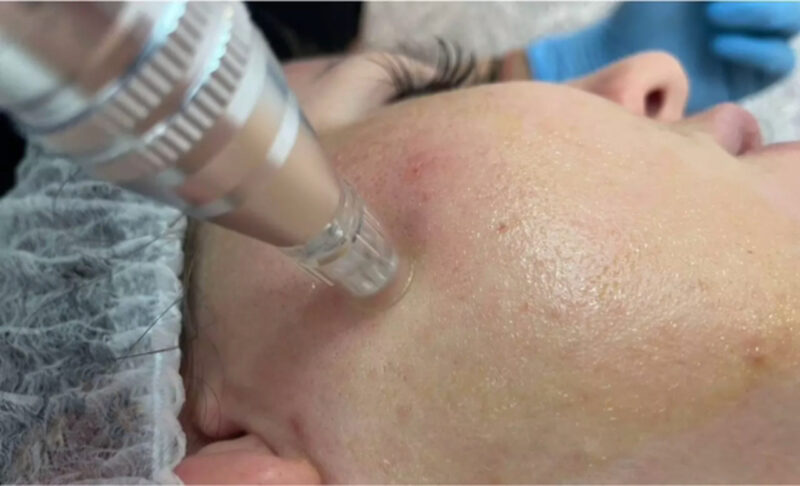 Mesotherapy head works on Joan's face