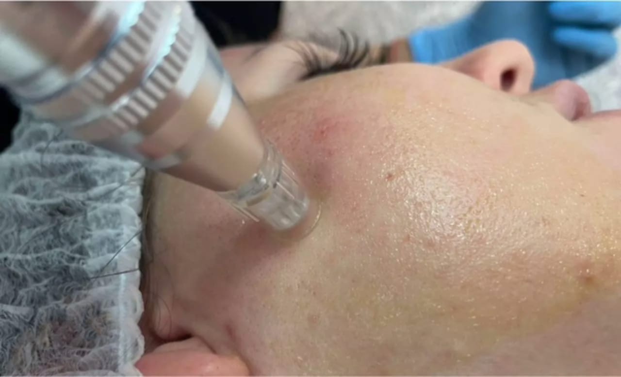 głowica do mezoterapii pracuje na twarzy Joanny