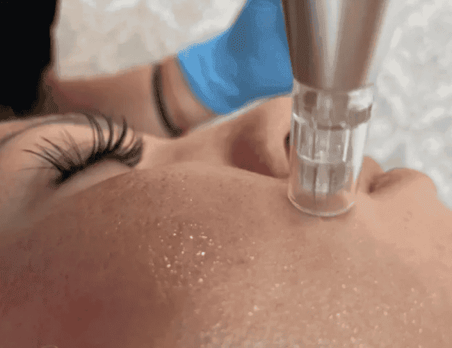 Mesotherapy head works on Joan's cheek