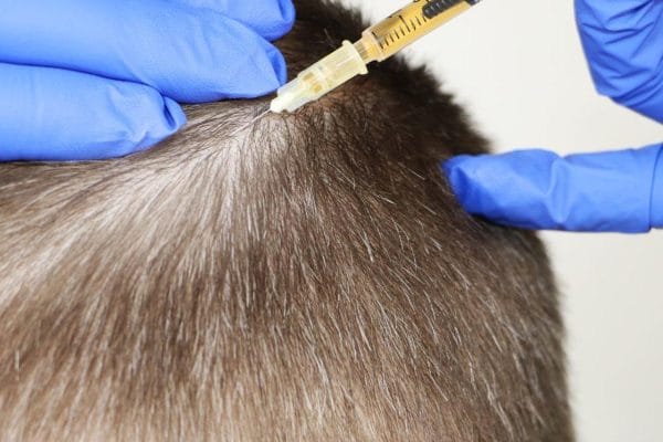 The beautician injects the product into the scalp