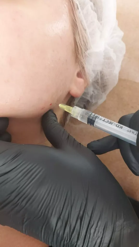 podawanie strzykawką preparatu w skórę szyji