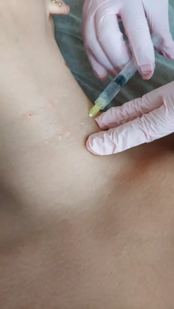 podawanie preparatu w skórę szyji