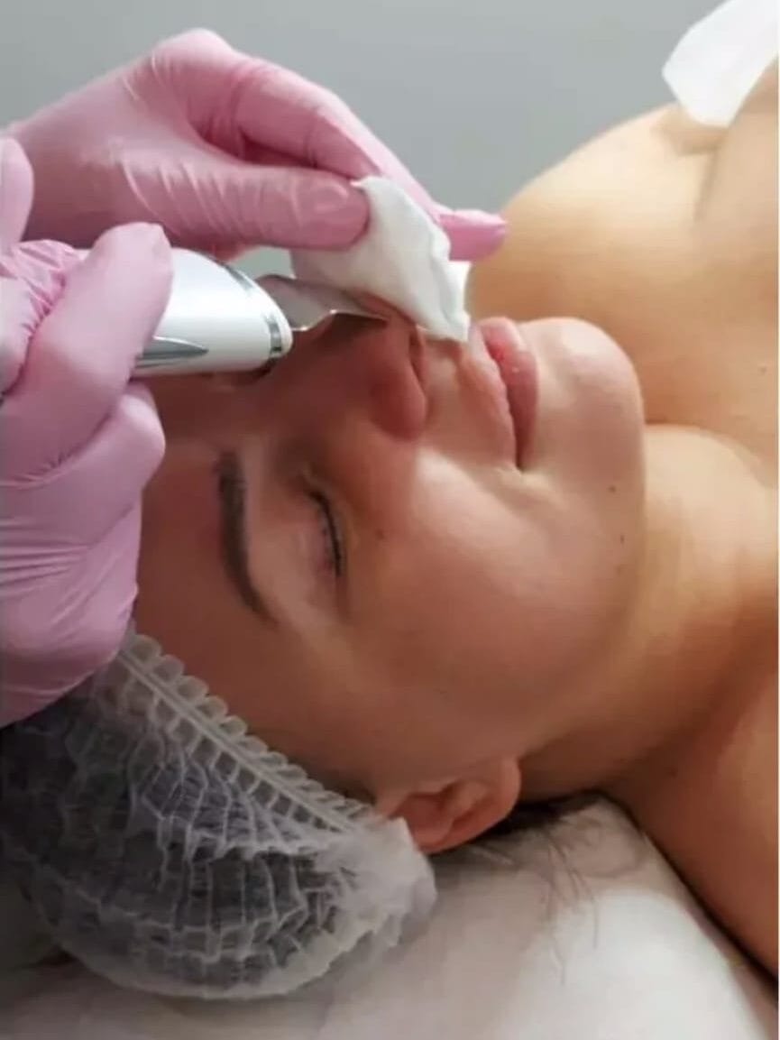 Asia during a cavitation peeling