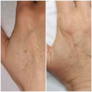effects-laser-removal-of-pigmentation-650 another hand after removal of the discoloration
