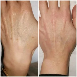 effects-removing-stains-on-donations-650x650 650 palm before and after removal of discoloration