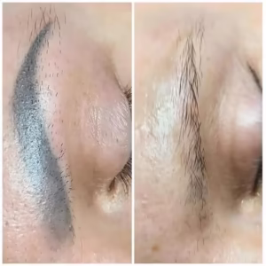 laser-makeup-removal-permanent-effect-after-treatment 650 removal of permanent makeup from eyebrows