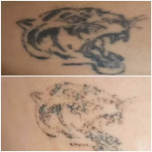 laser-tattoo-removal-effect-after-1-treatment 650 Tattoo removal - the effect after the first treatment
