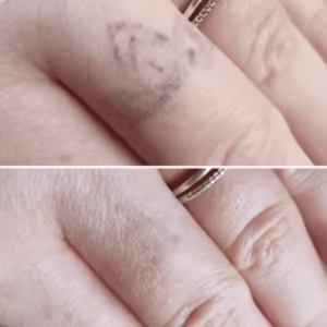 650 tattoo removed fingers - after tattoo removal
