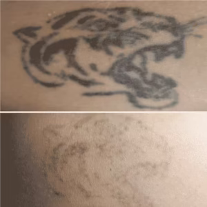 tattoo removal 650 tattoo removed - after another treatment - effect